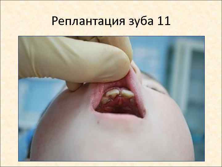 Реплантация зуба 11 