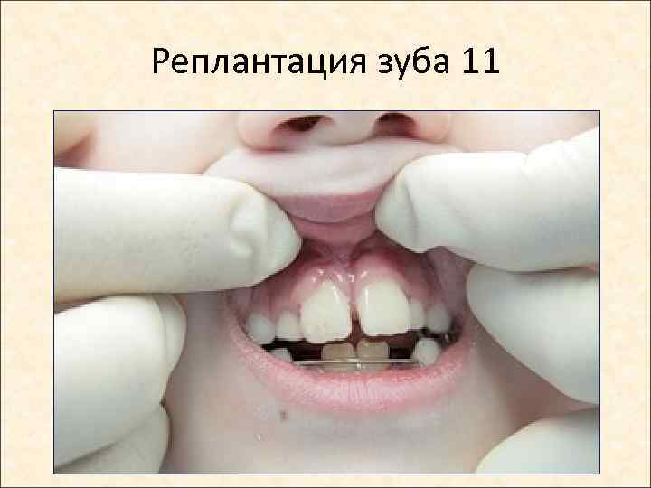 Реплантация зуба 11 
