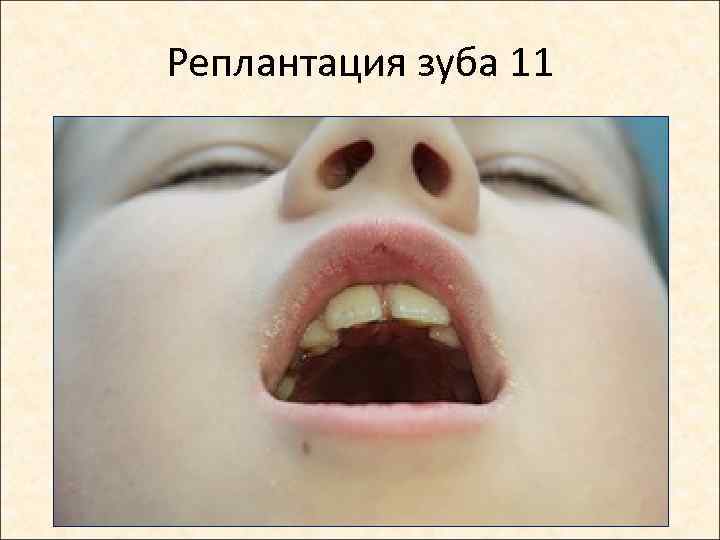 Реплантация зуба 11 