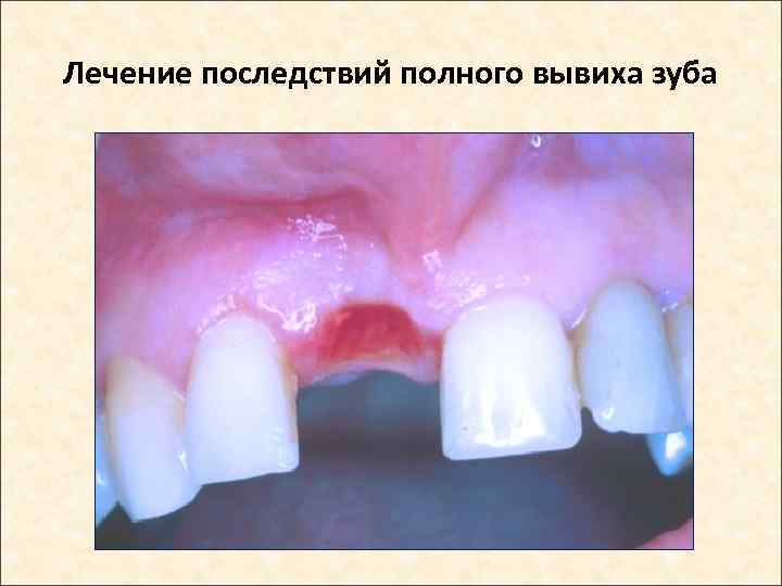 Лечение последствий полного вывиха зуба 