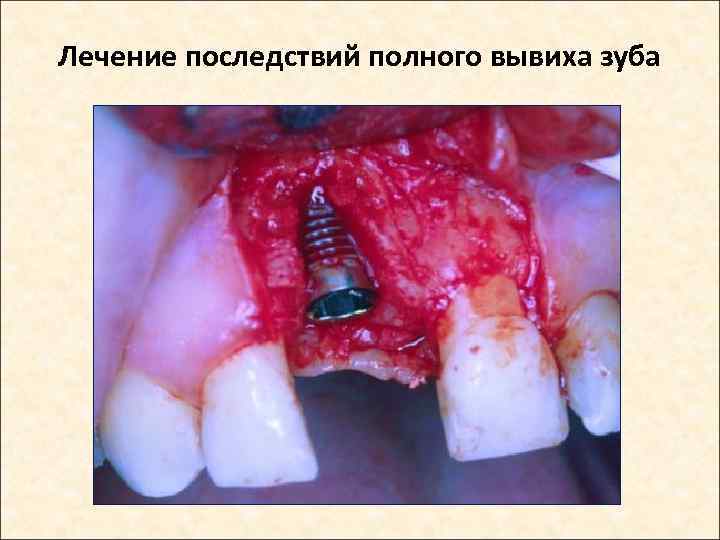 Лечение последствий полного вывиха зуба 