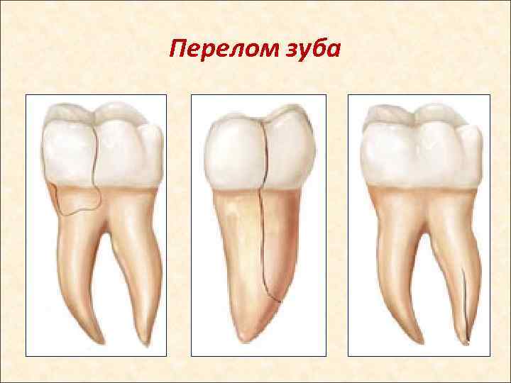 Перелом зуба 
