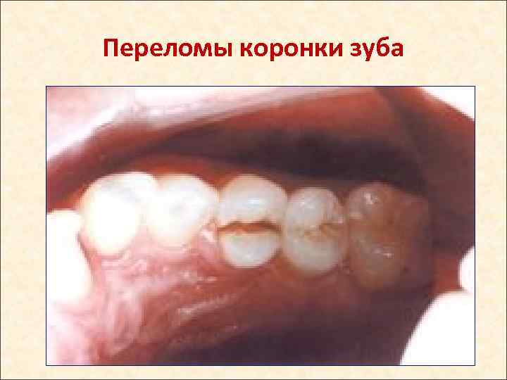 Переломы коронки зуба 