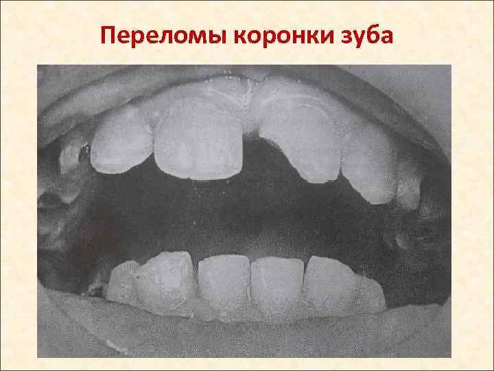 Переломы коронки зуба 