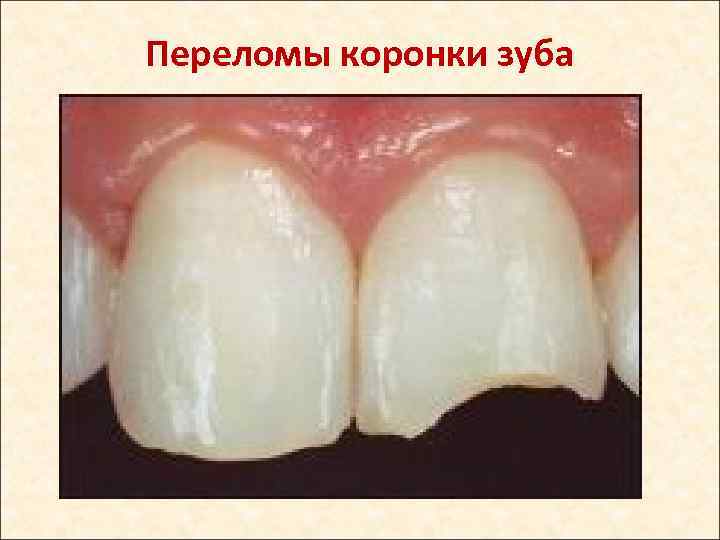 Переломы коронки зуба 