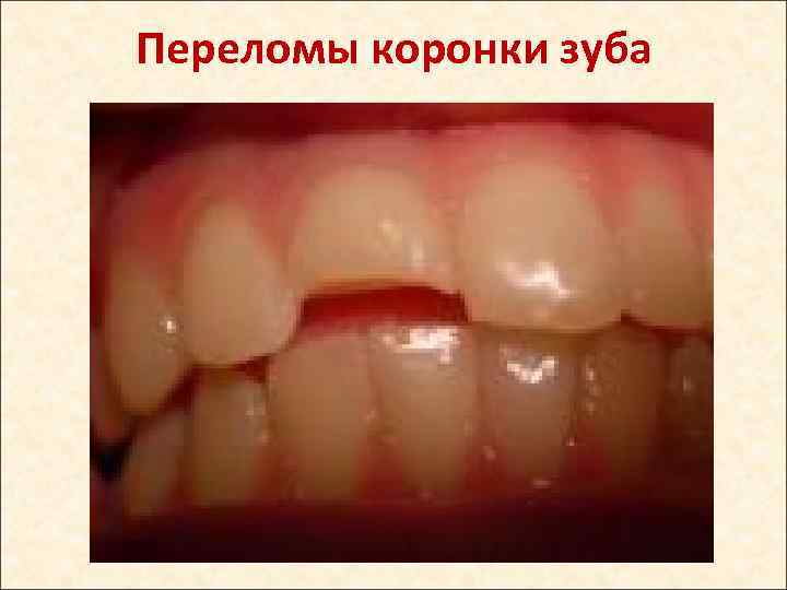 Переломы коронки зуба 