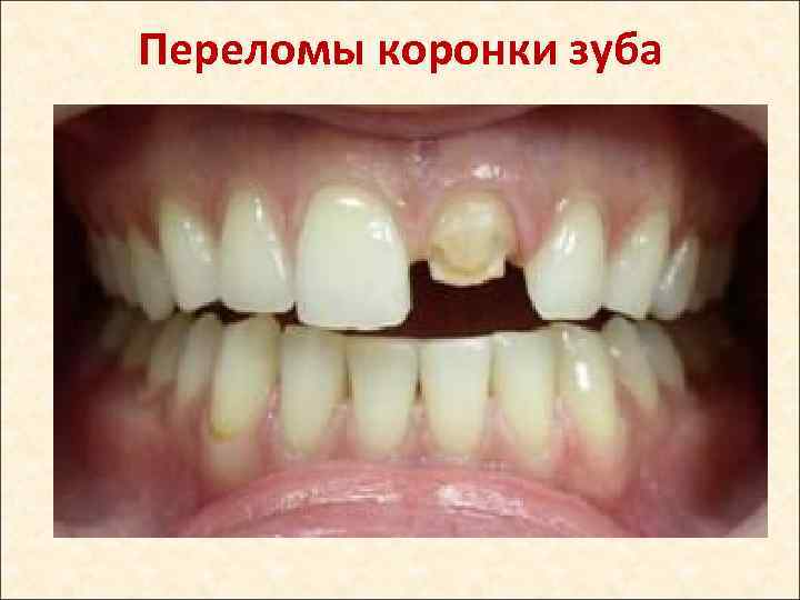 Переломы коронки зуба 
