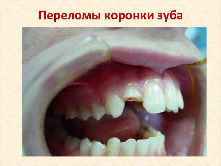 Переломы коронки зуба 