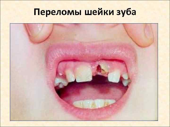 Переломы шейки зуба 