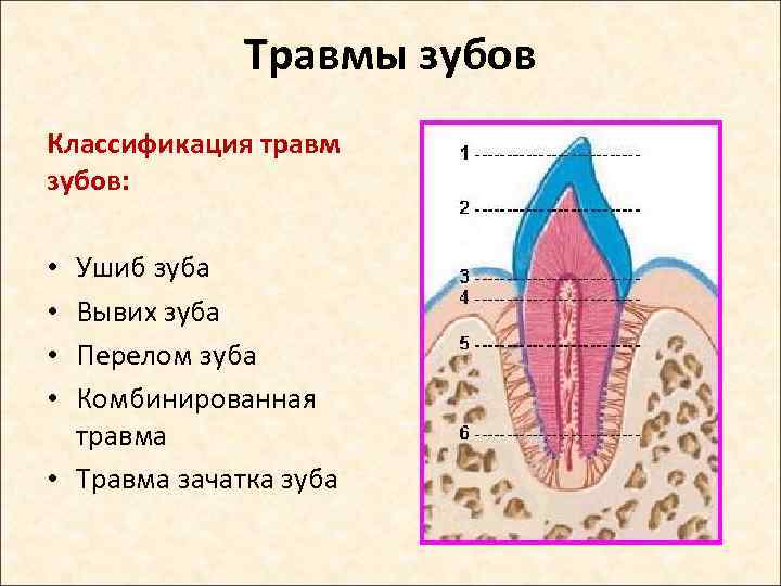 Травмы зубов Классификация травм зубов: Ушиб зуба Вывих зуба Перелом зуба Комбинированная травма •