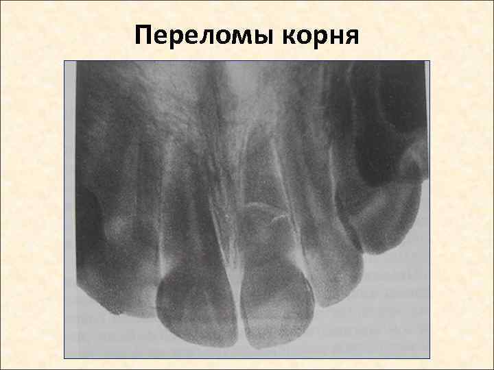 Переломы корня 