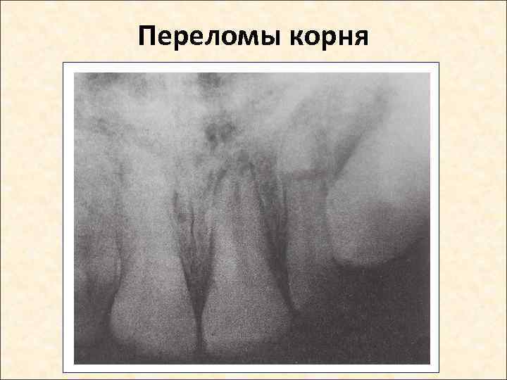 Переломы корня 