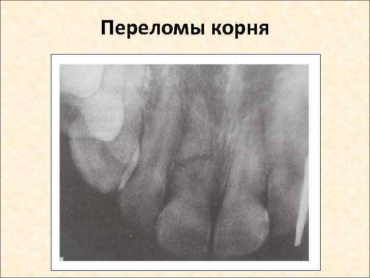 Переломы корня 