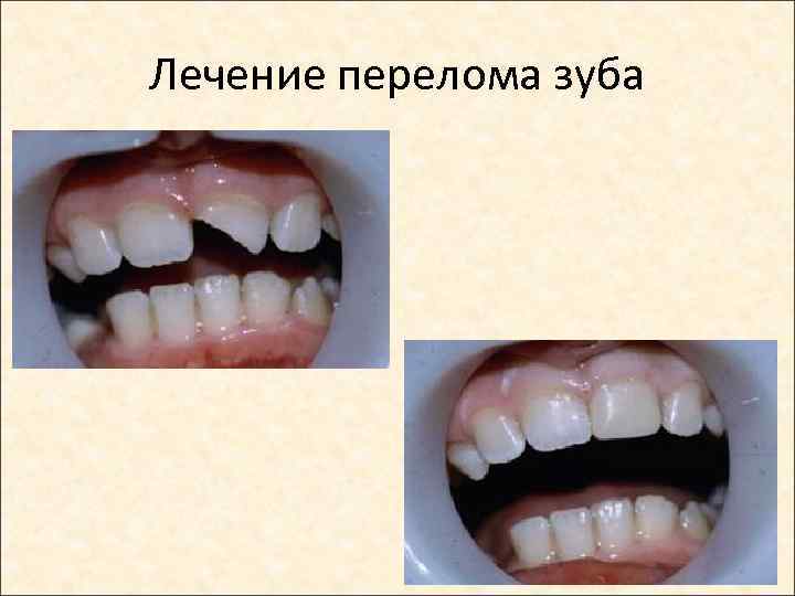 Лечение перелома зуба 