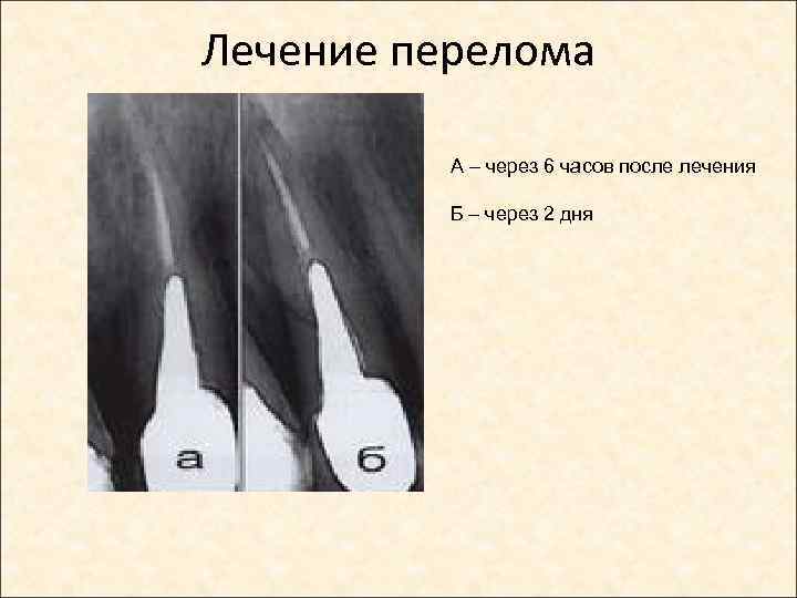 Лечение перелома А – через 6 часов после лечения Б – через 2 дня