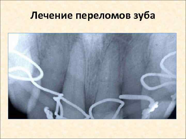 Лечение переломов зуба 