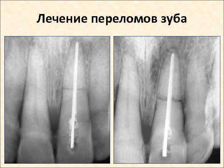 Лечение переломов зуба 