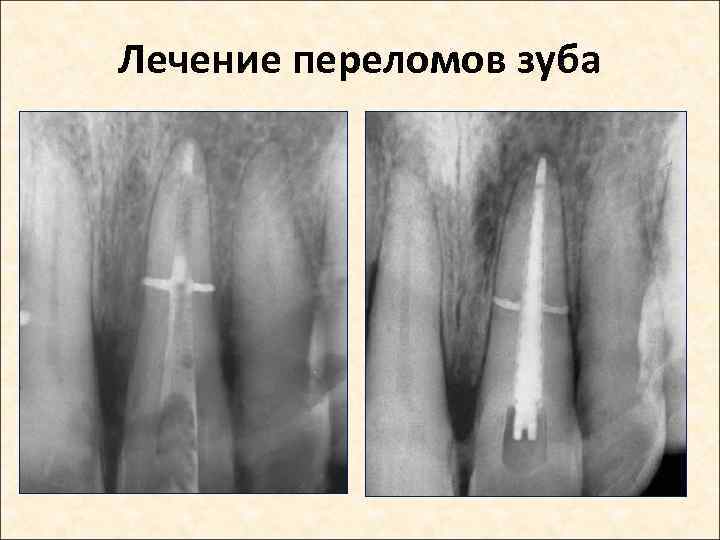 Лечение переломов зуба 