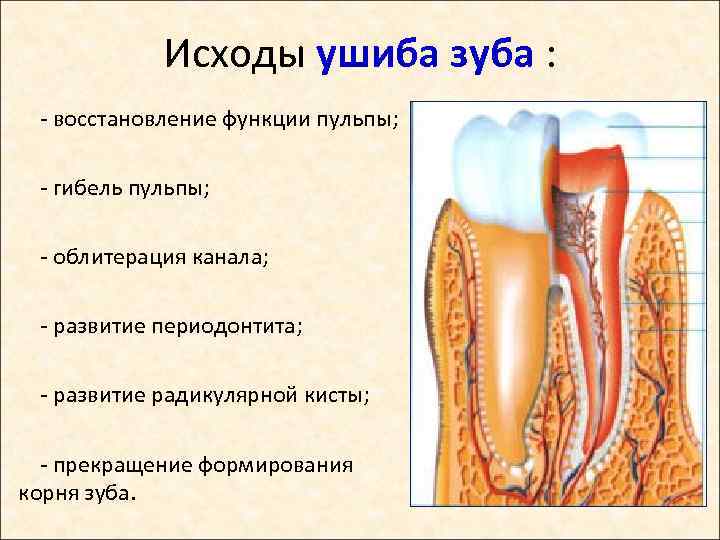Исходы ушиба зуба : - восстановление функции пульпы; - гибель пульпы; - облитерация канала;