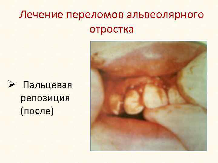 Лечение переломов альвеолярного отростка Ø Пальцевая репозиция (после) 