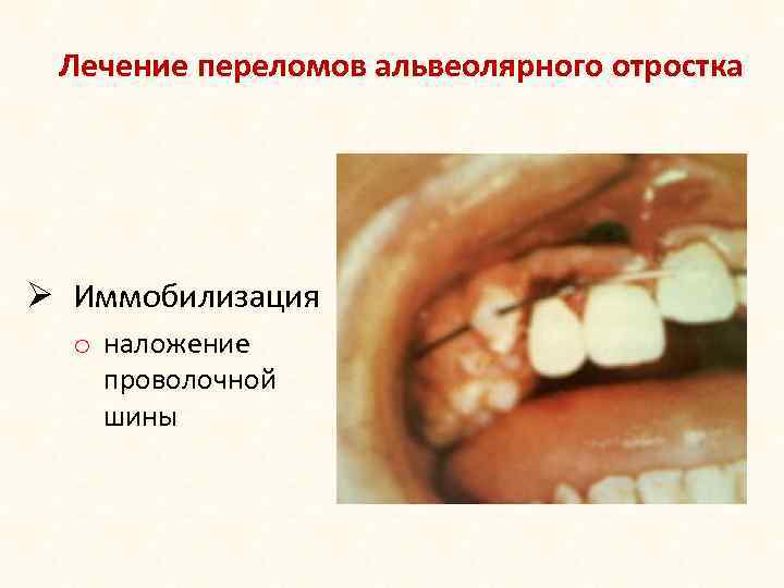 Лечение переломов альвеолярного отростка Ø Иммобилизация o наложение проволочной шины 