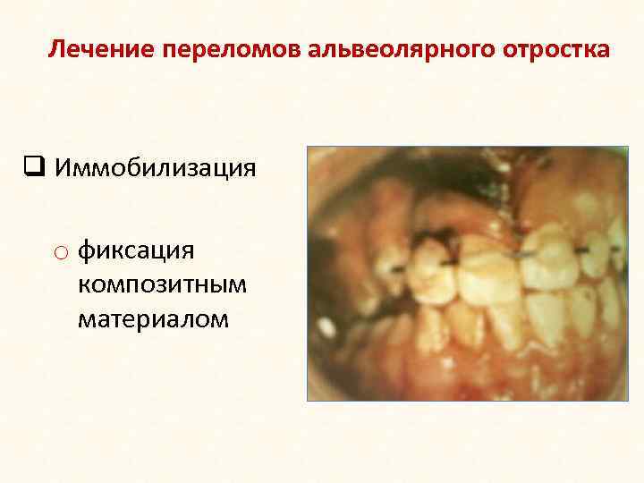 Лечение переломов альвеолярного отростка q Иммобилизация o фиксация композитным материалом 