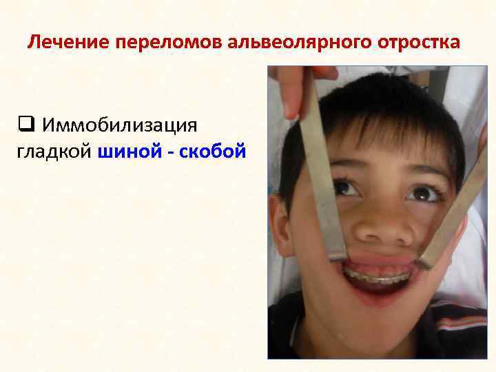 Лечение переломов альвеолярного отростка q Иммобилизация гладкой шиной - скобой 