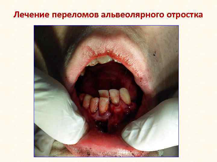 Лечение переломов альвеолярного отростка 
