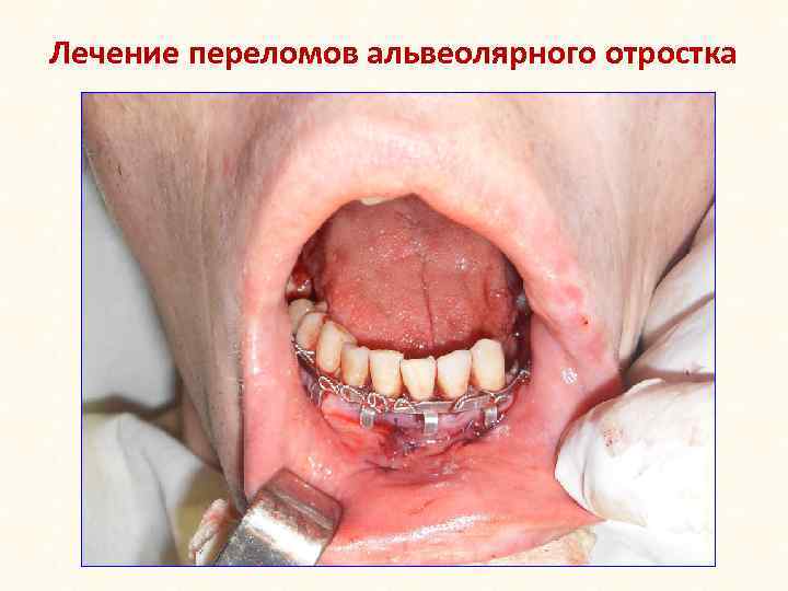 Лечение переломов альвеолярного отростка 