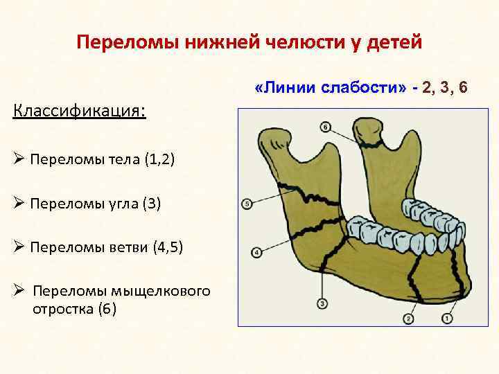 Переломы нижней челюсти у детей «Линии слабости» - 2, 3, 6 Классификация: Ø Переломы