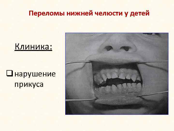 Переломы нижней челюсти у детей Клиника: q нарушение прикуса 