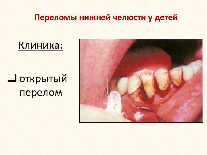 Переломы нижней челюсти у детей Клиника: q открытый перелом 