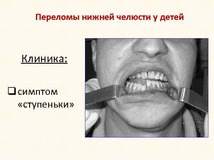 Переломы нижней челюсти у детей Клиника: q симптом «ступеньки» 