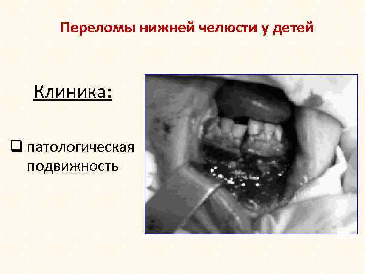 Переломы нижней челюсти у детей Клиника: q патологическая подвижность 