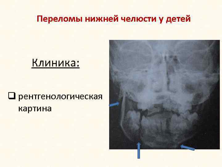 Переломы нижней челюсти у детей Клиника: q рентгенологическая картина 