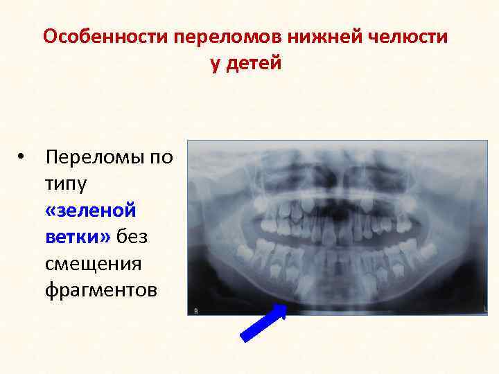 Особенности переломов нижней челюсти у детей • Переломы по типу «зеленой ветки» без смещения