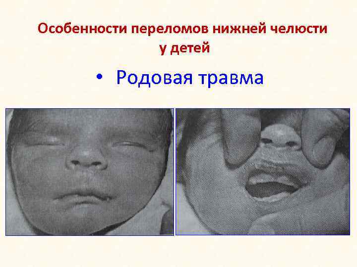 Особенности переломов нижней челюсти у детей • Родовая травма 