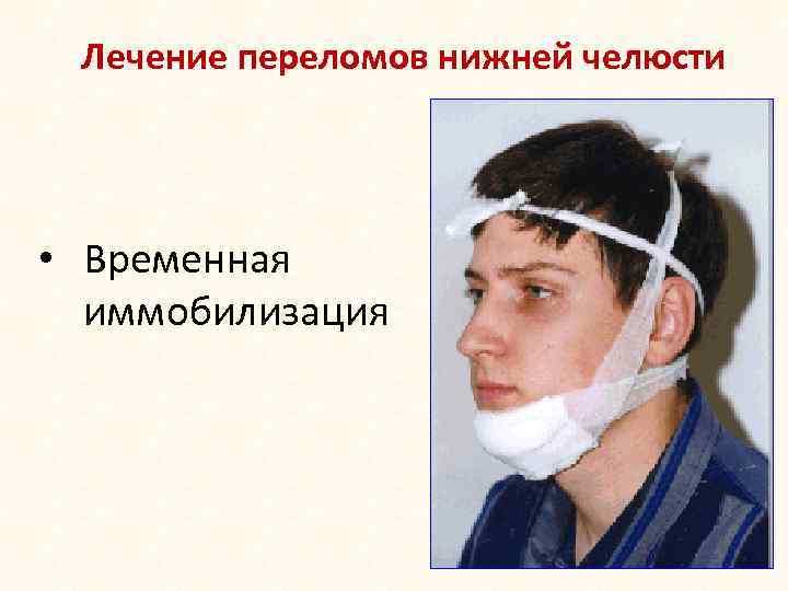 Лечение переломов нижней челюсти • Временная иммобилизация 