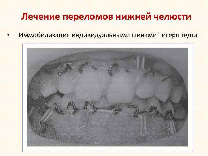 Лечение переломов нижней челюсти • Иммобилизация индивидуальными шинами Тигерштедта 