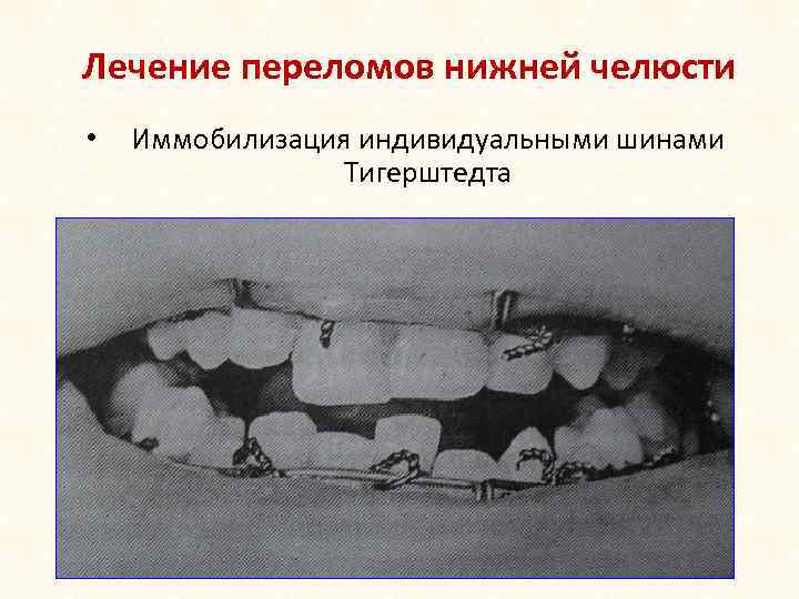 Лечение переломов нижней челюсти • Иммобилизация индивидуальными шинами Тигерштедта 
