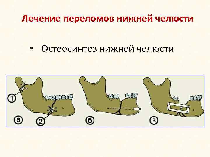 Лечение переломов нижней челюсти • Остеосинтез нижней челюсти 