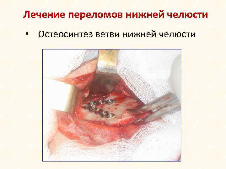 Лечение переломов нижней челюсти • Остеосинтез ветви нижней челюсти 