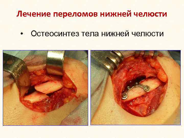 Лечение переломов нижней челюсти • Остеосинтез тела нижней челюсти 