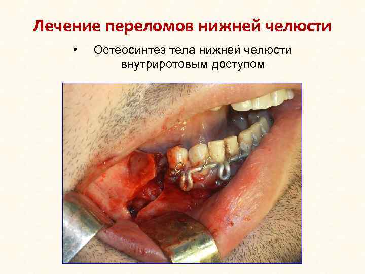 Лечение переломов нижней челюсти • Остеосинтез тела нижней челюсти внутриротовым доступом 