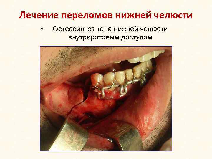 Лечение переломов нижней челюсти • Остеосинтез тела нижней челюсти внутриротовым доступом 