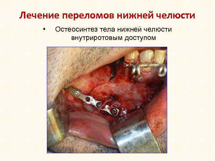 Лечение переломов нижней челюсти • Остеосинтез тела нижней челюсти внутриротовым доступом 