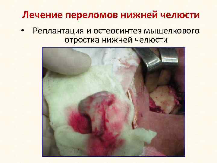 Лечение переломов нижней челюсти • Реплантация и остеосинтез мыщелкового отростка нижней челюсти 
