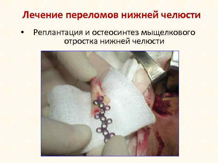 Лечение переломов нижней челюсти • Реплантация и остеосинтез мыщелкового отростка нижней челюсти 
