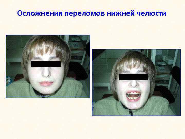 Осложнения переломов нижней челюсти 