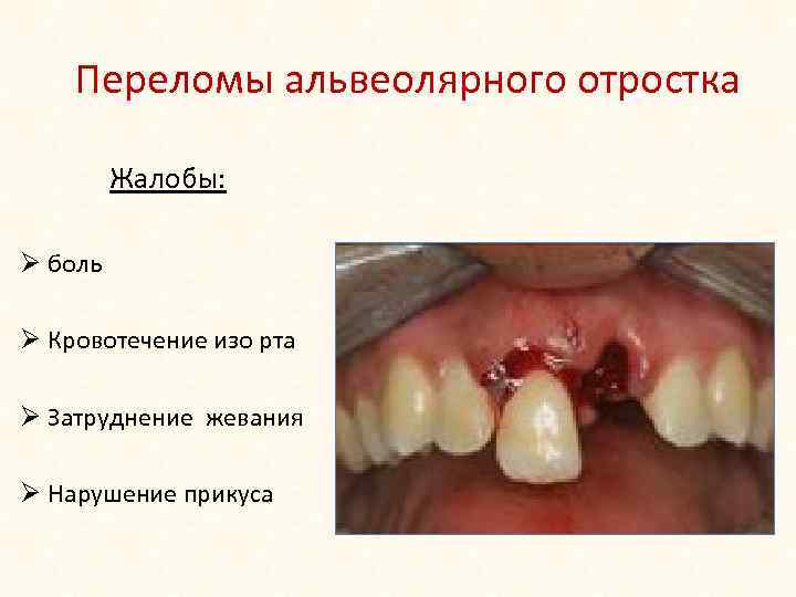 Переломы альвеолярного отростка Жалобы: Ø боль Ø Кровотечение изо рта Ø Затруднение жевания Ø